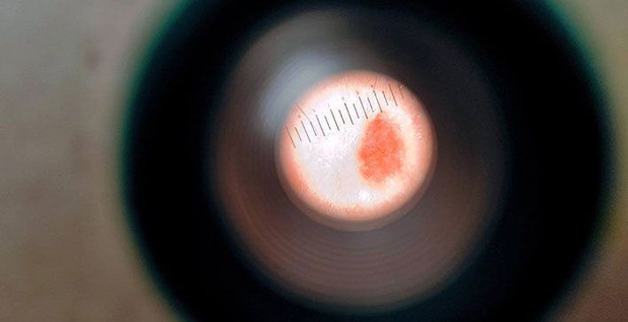 Кировчан приглашают обследовать родинки